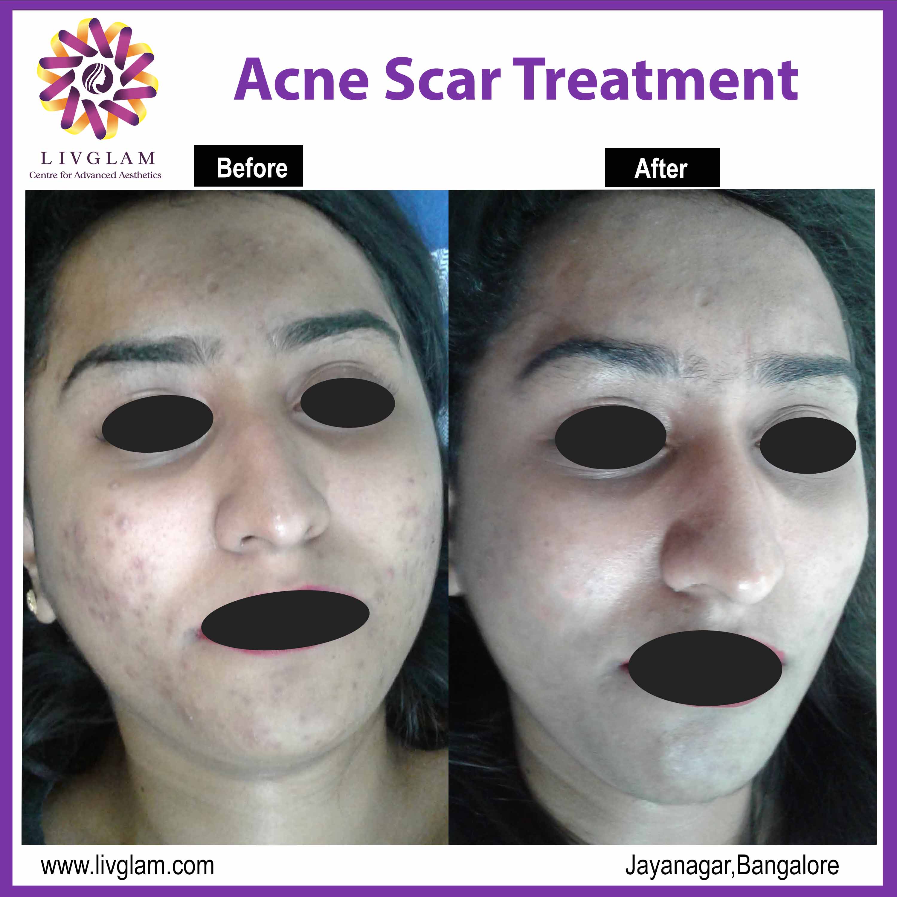 Acne scar treatment in Bangalore