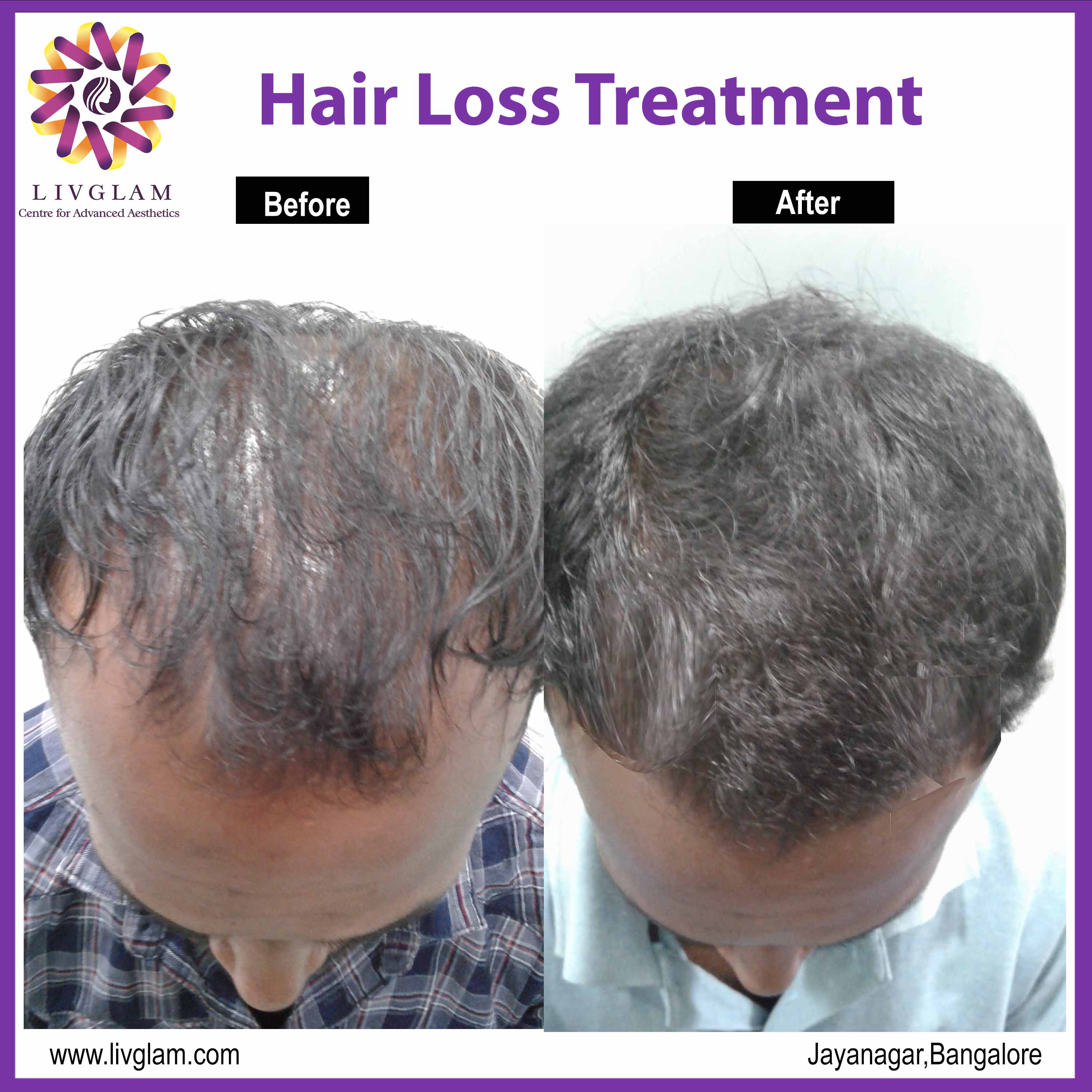 Cost of hair loss treatment in Bangalore