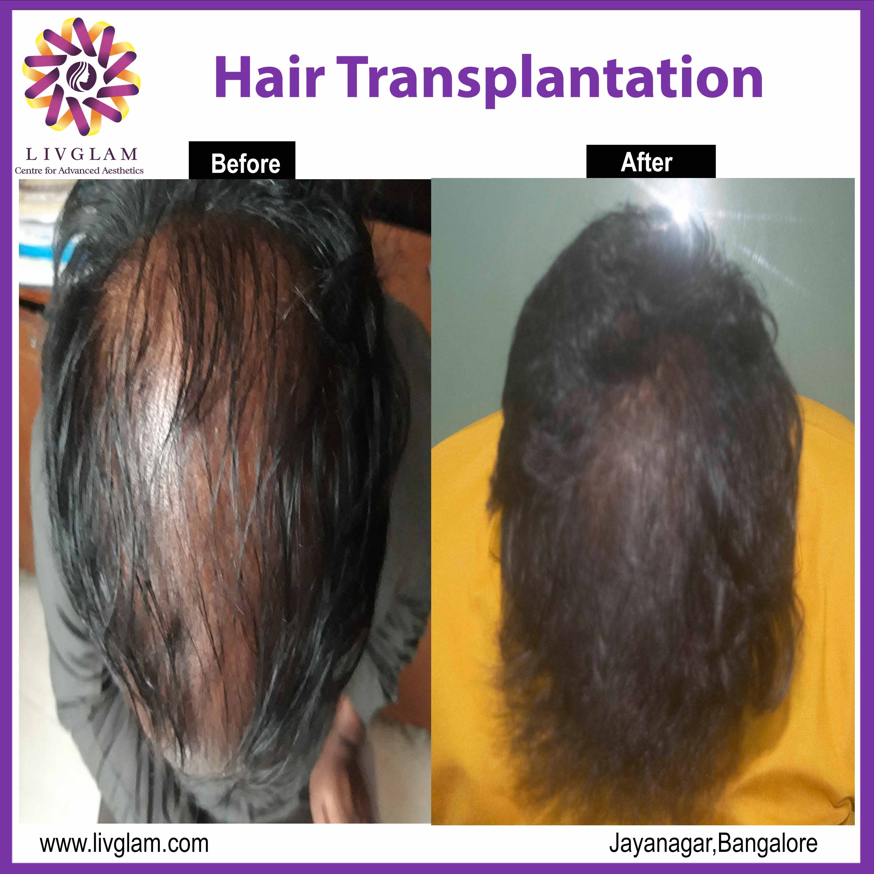 cost of hair transplant in bangalore