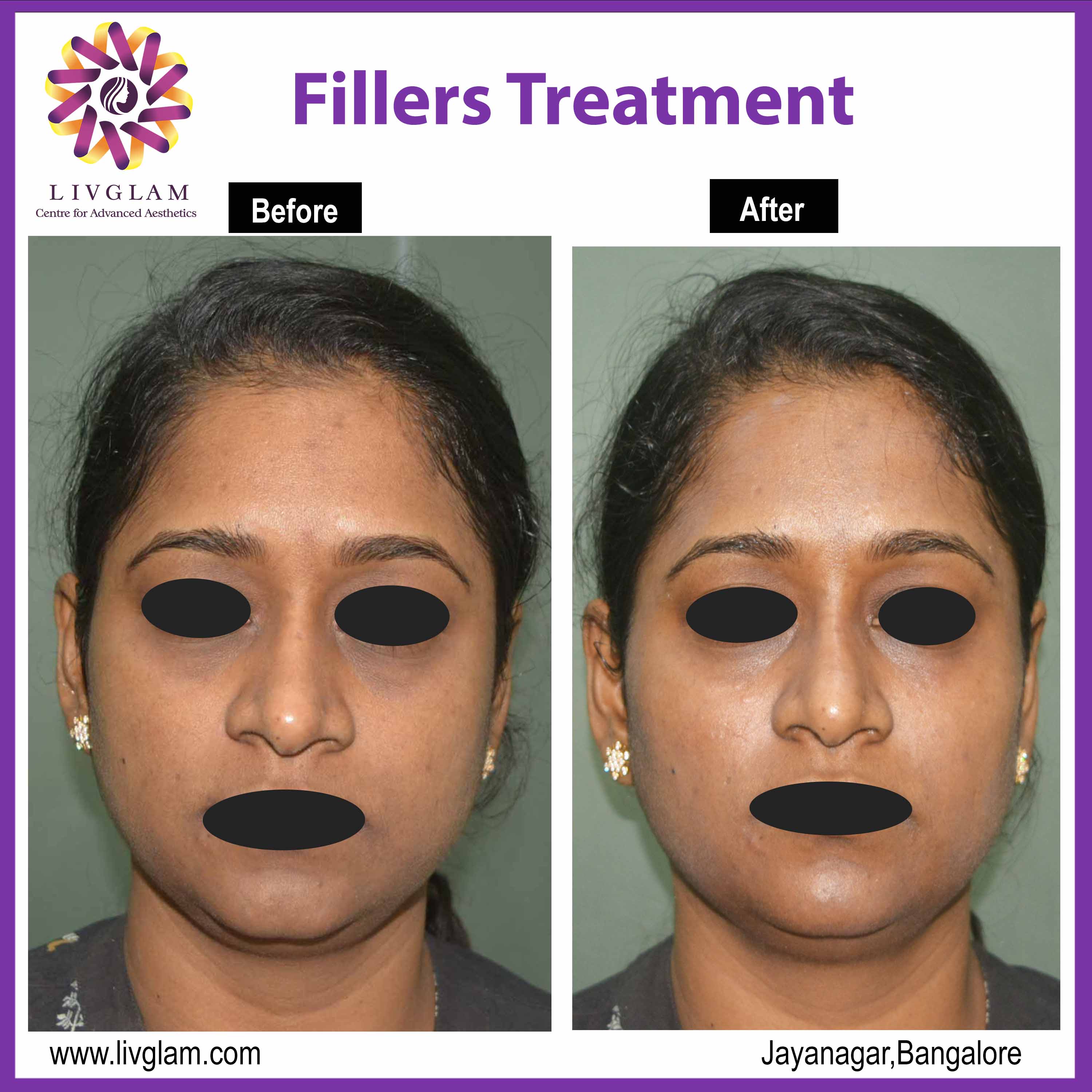 Dermal fillers before and after