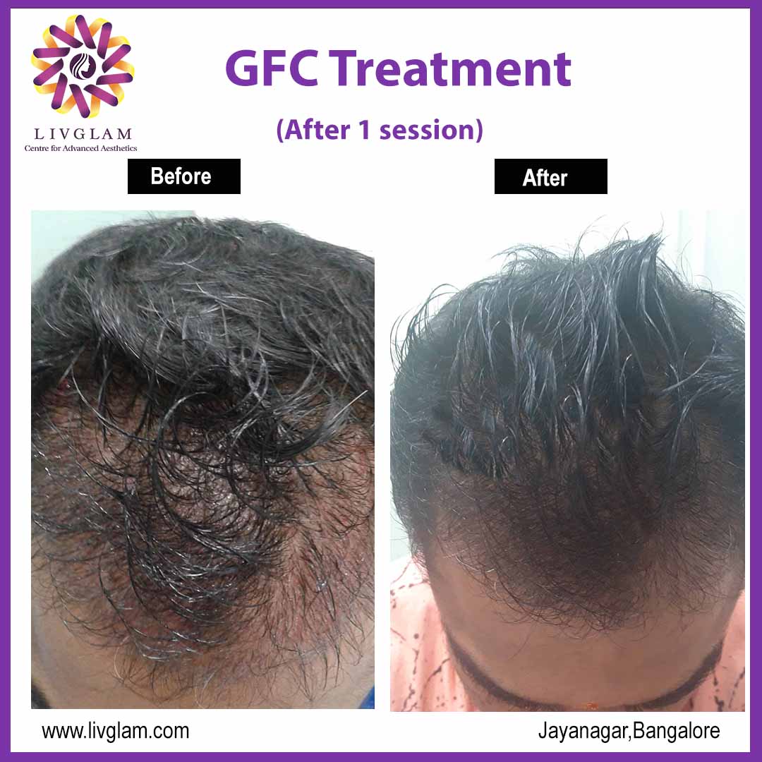 gfc for hair regrowth in Bangalore