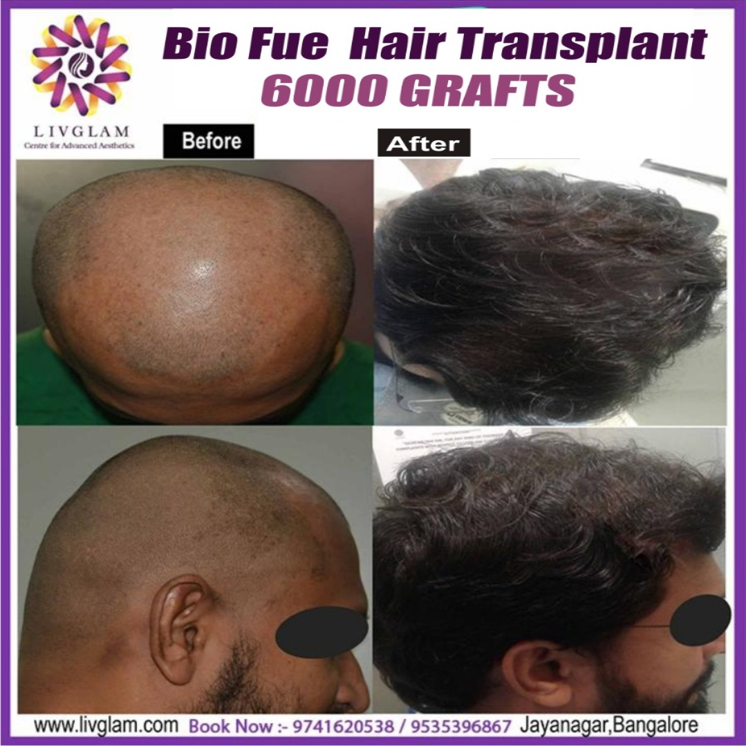 gfc hair treatment cost in bangalore