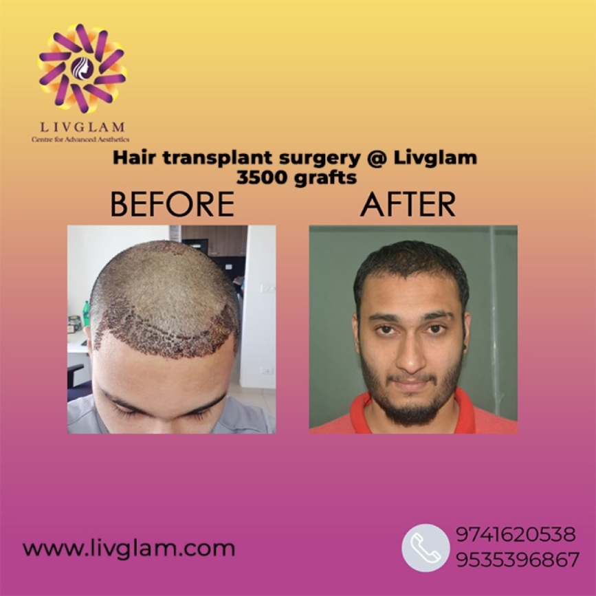 Best Hair Transplantation in Bangalore Hair Grafting Cost in Bangalore
