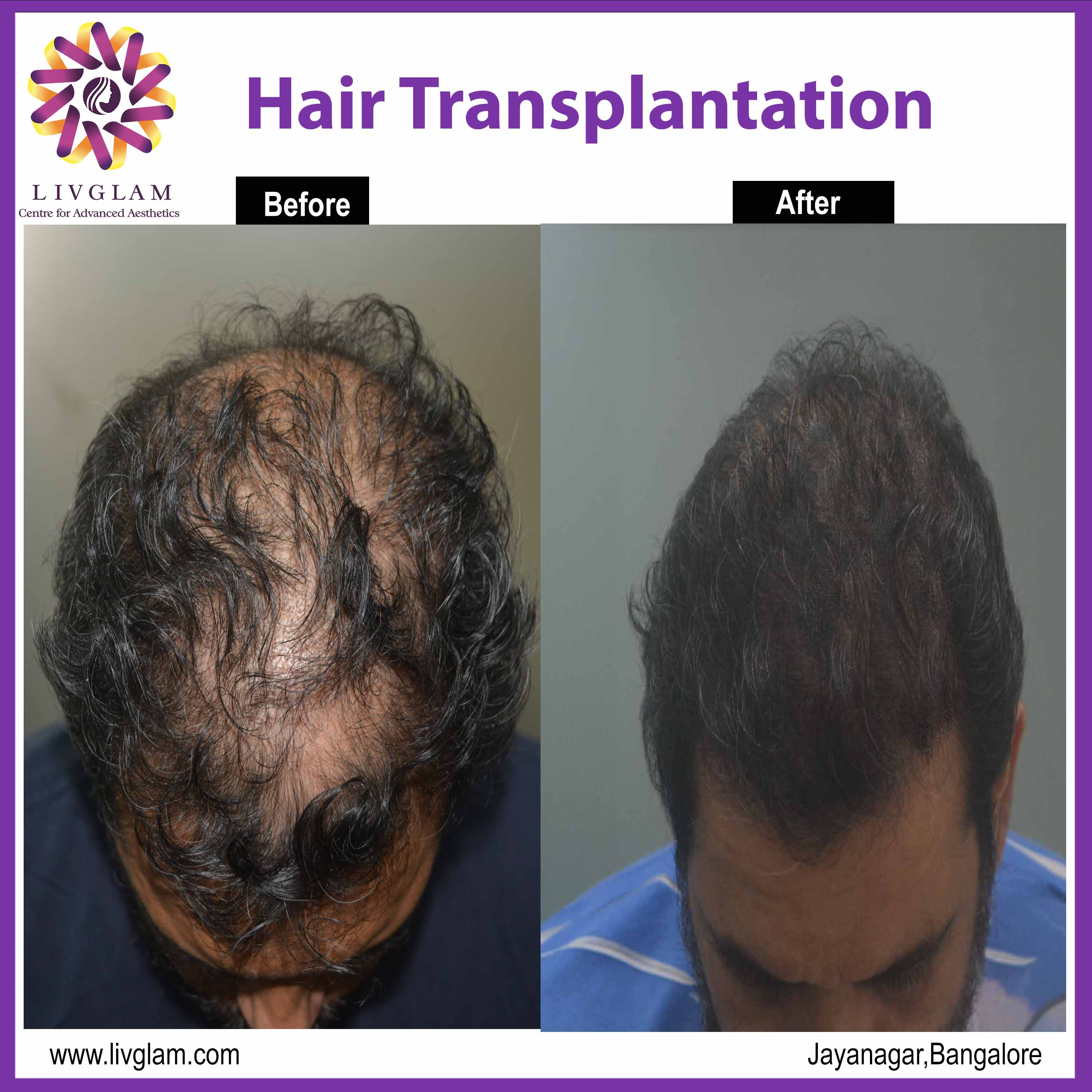 hair loss treatment in Bangalore