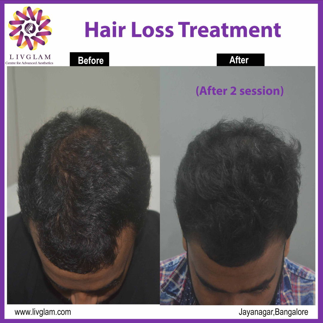 hair regrowth treatment in bangalore
