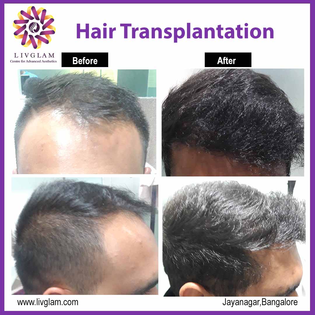 hair transplant bangalore