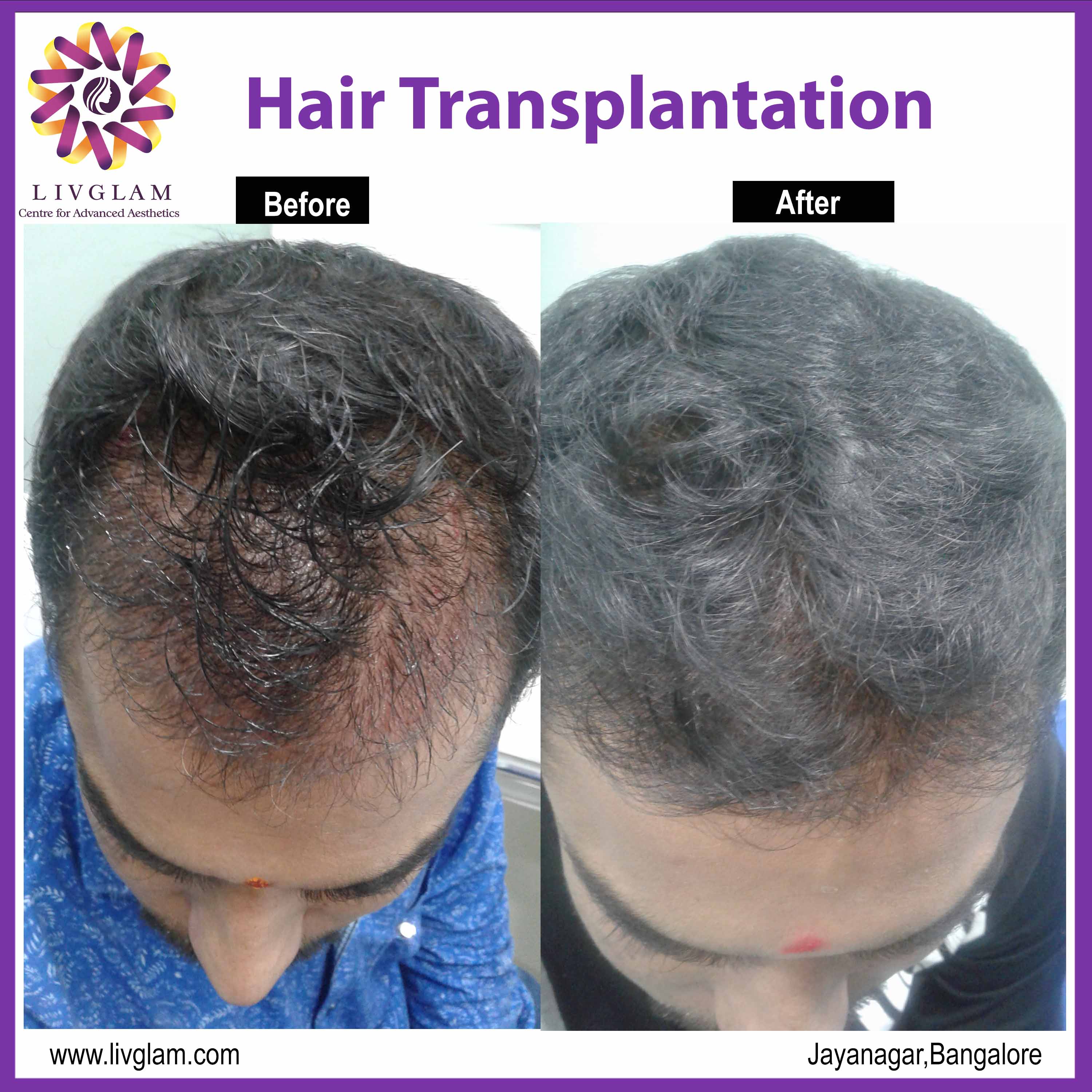 hair transplant cost bangalore