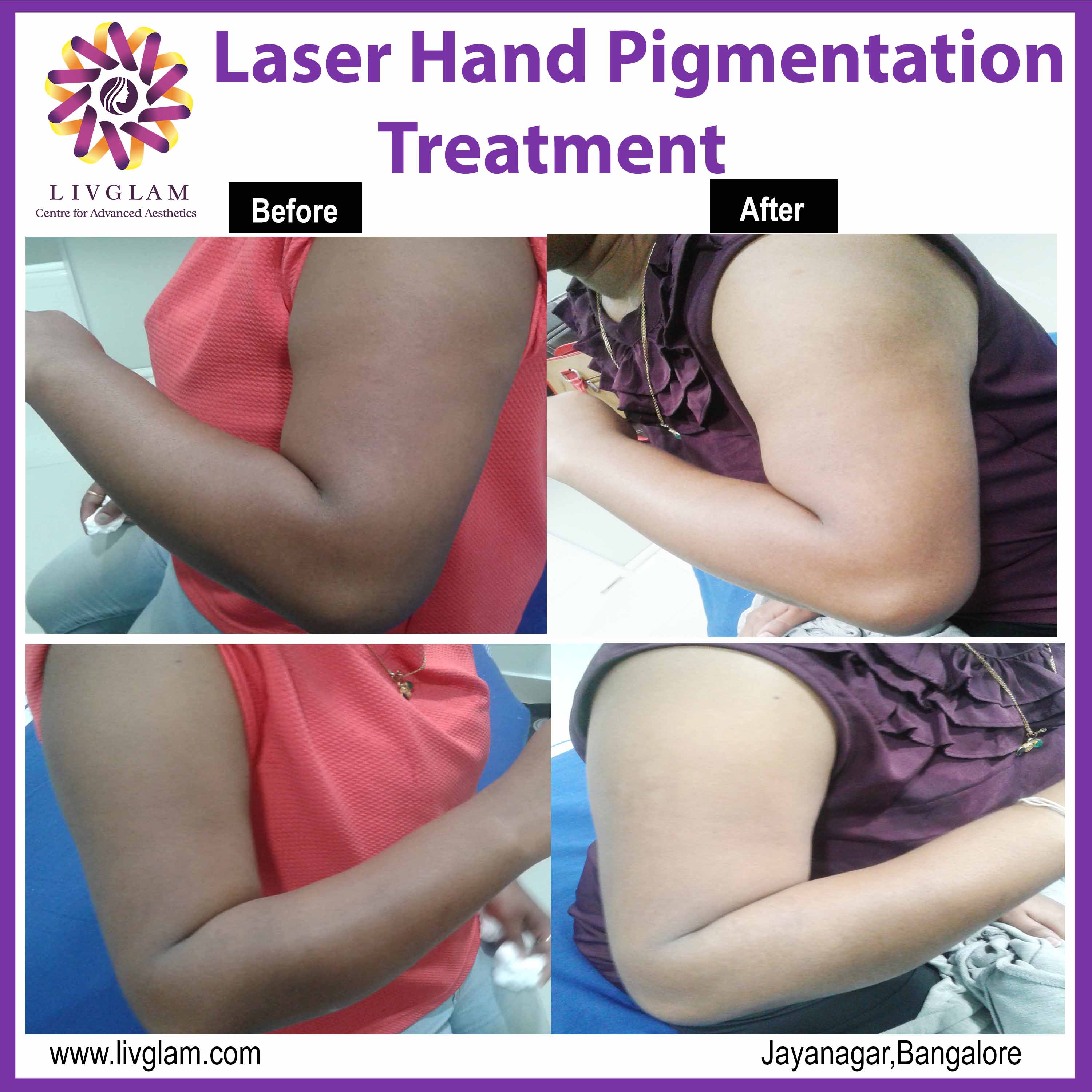 Laser pigmentation treatment for hands