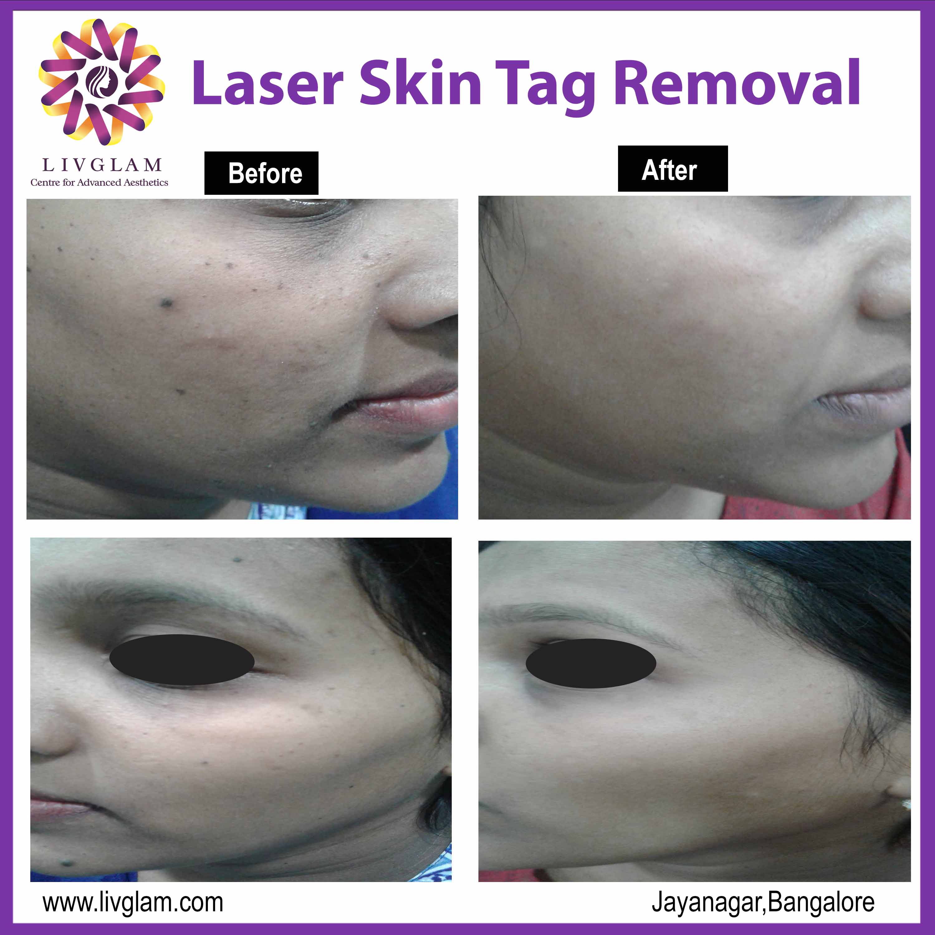 Laser skin tag removal cost in Bangalore