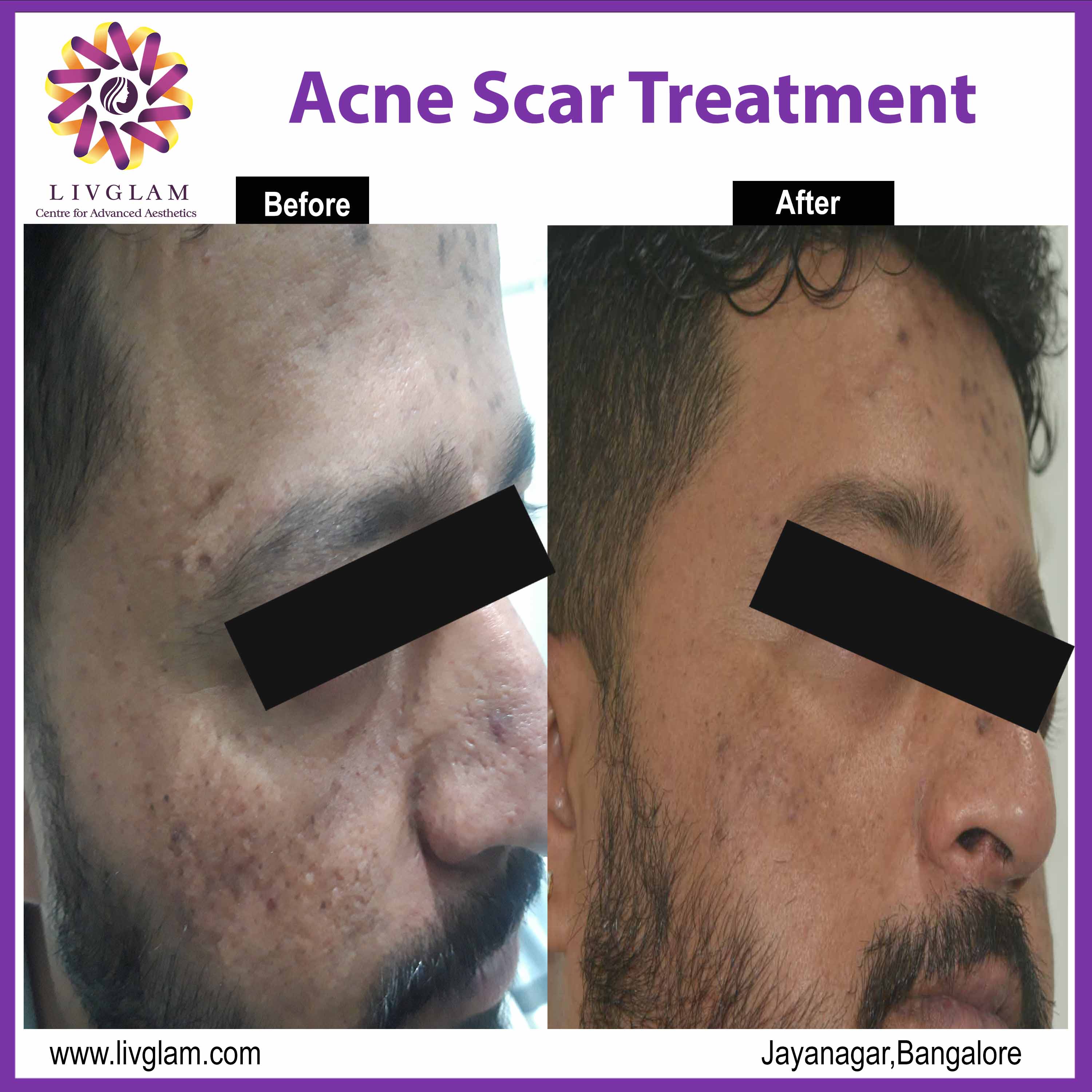 laser treatment for acne scars cost in bangalore