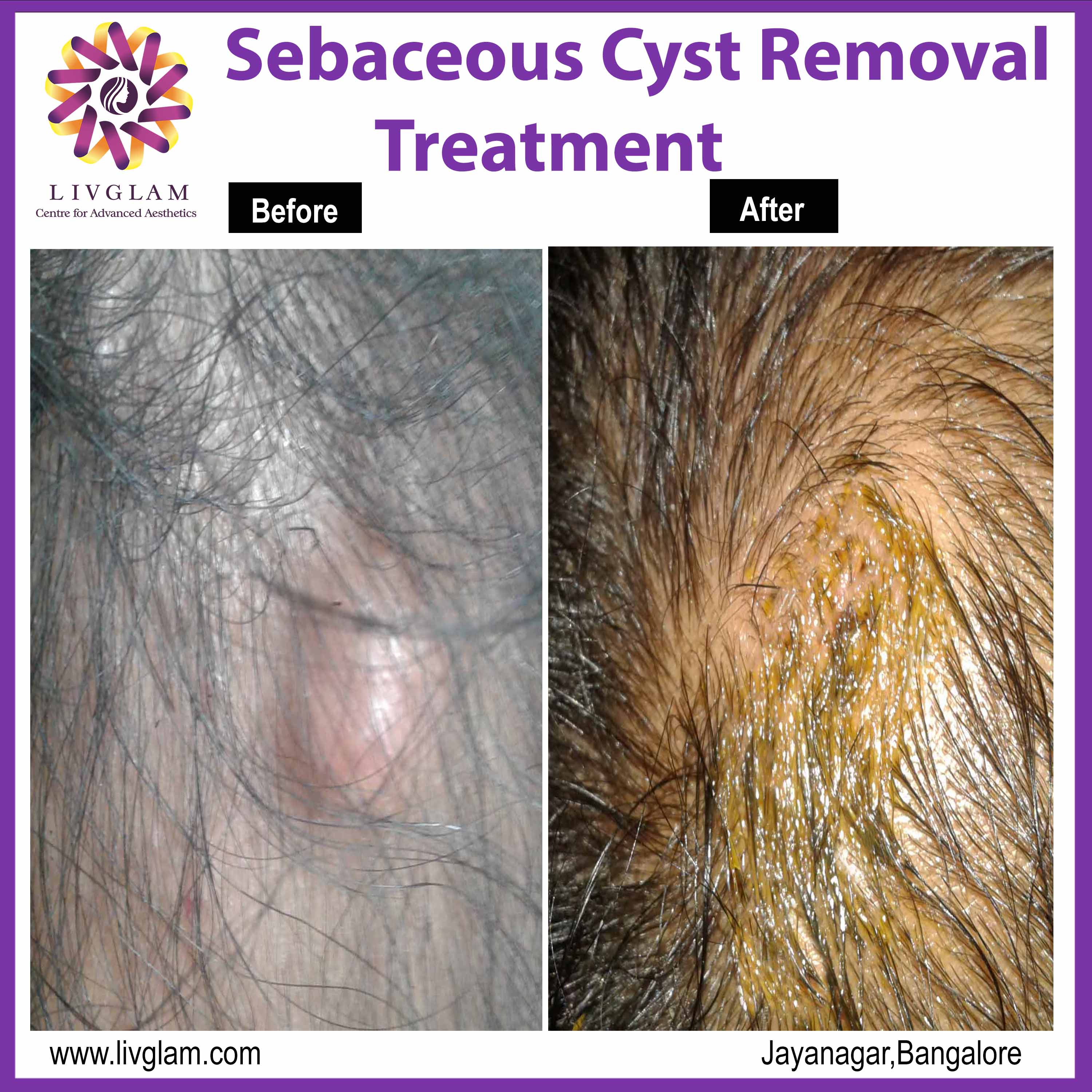 Sebaceous cyst removal treatment in Bangalore