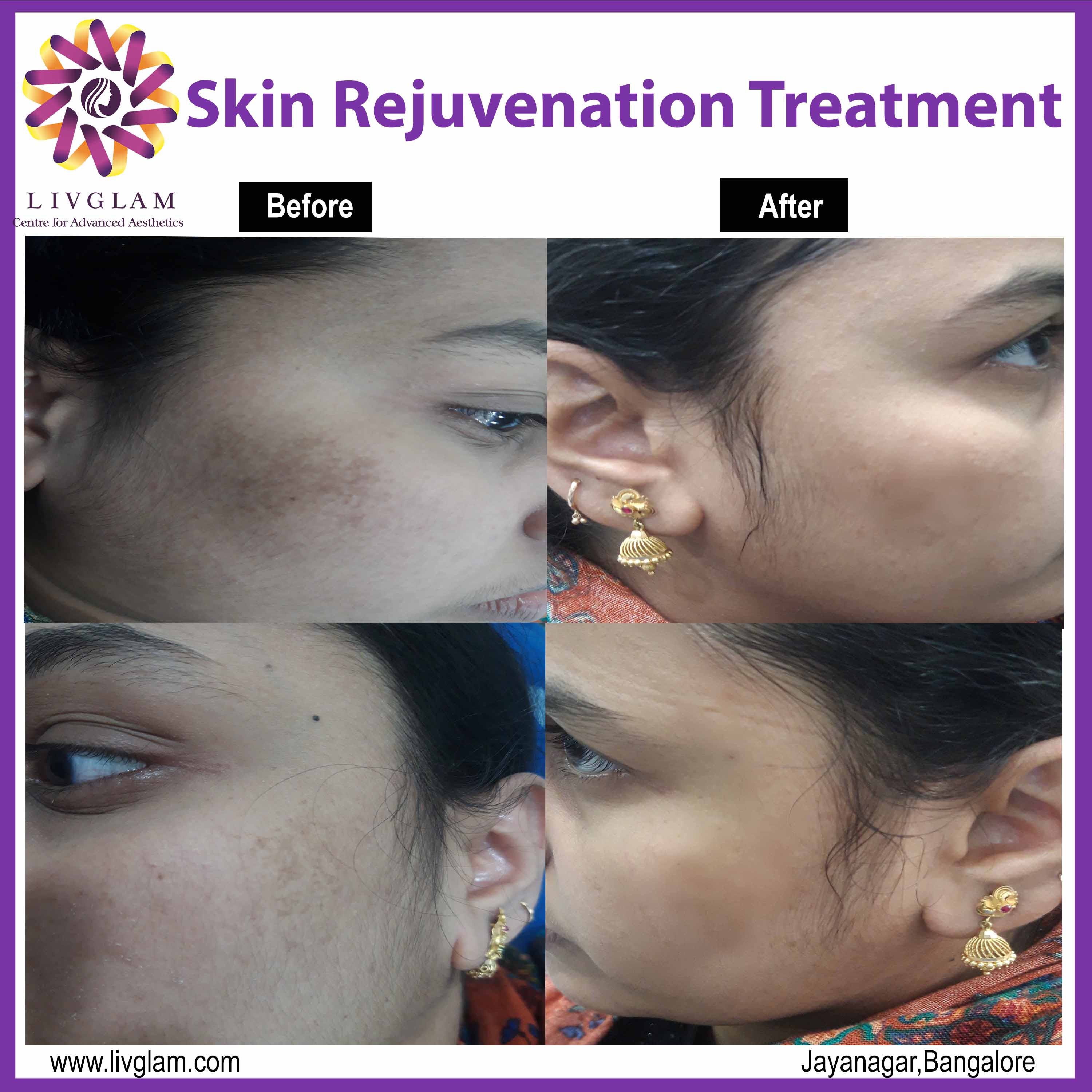 skin lightening treatment in Bangalore