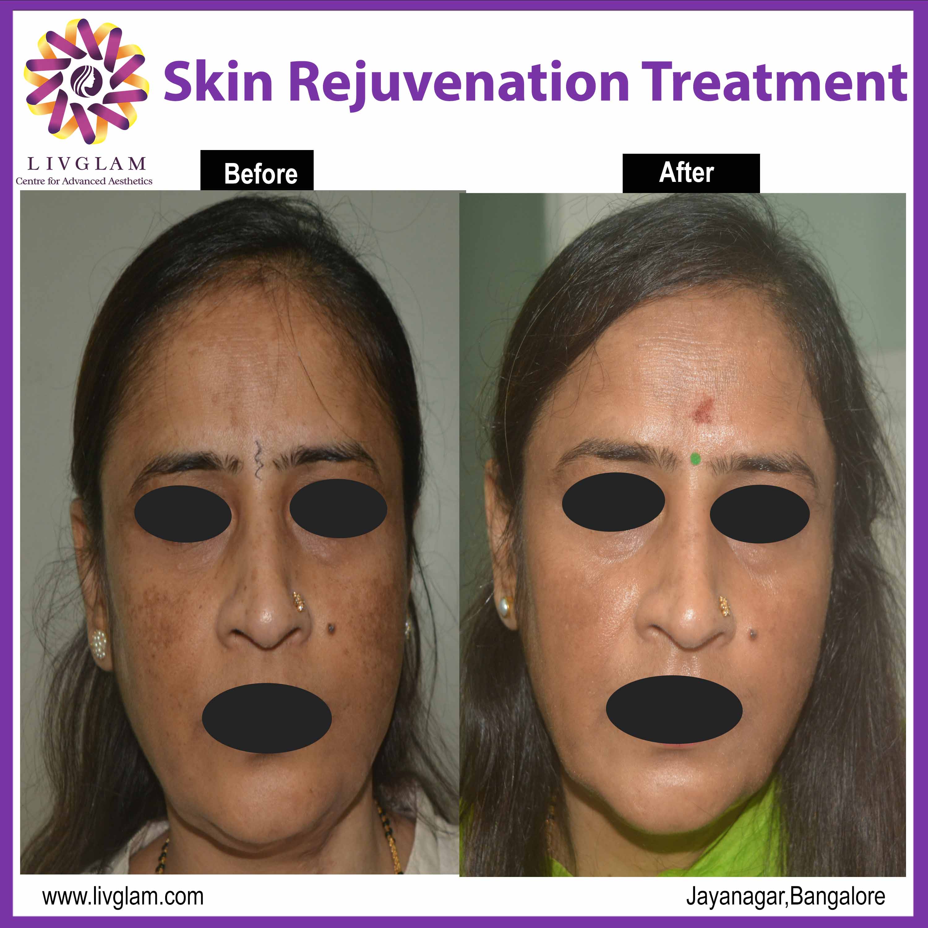 skin rejuvenation treatment cost