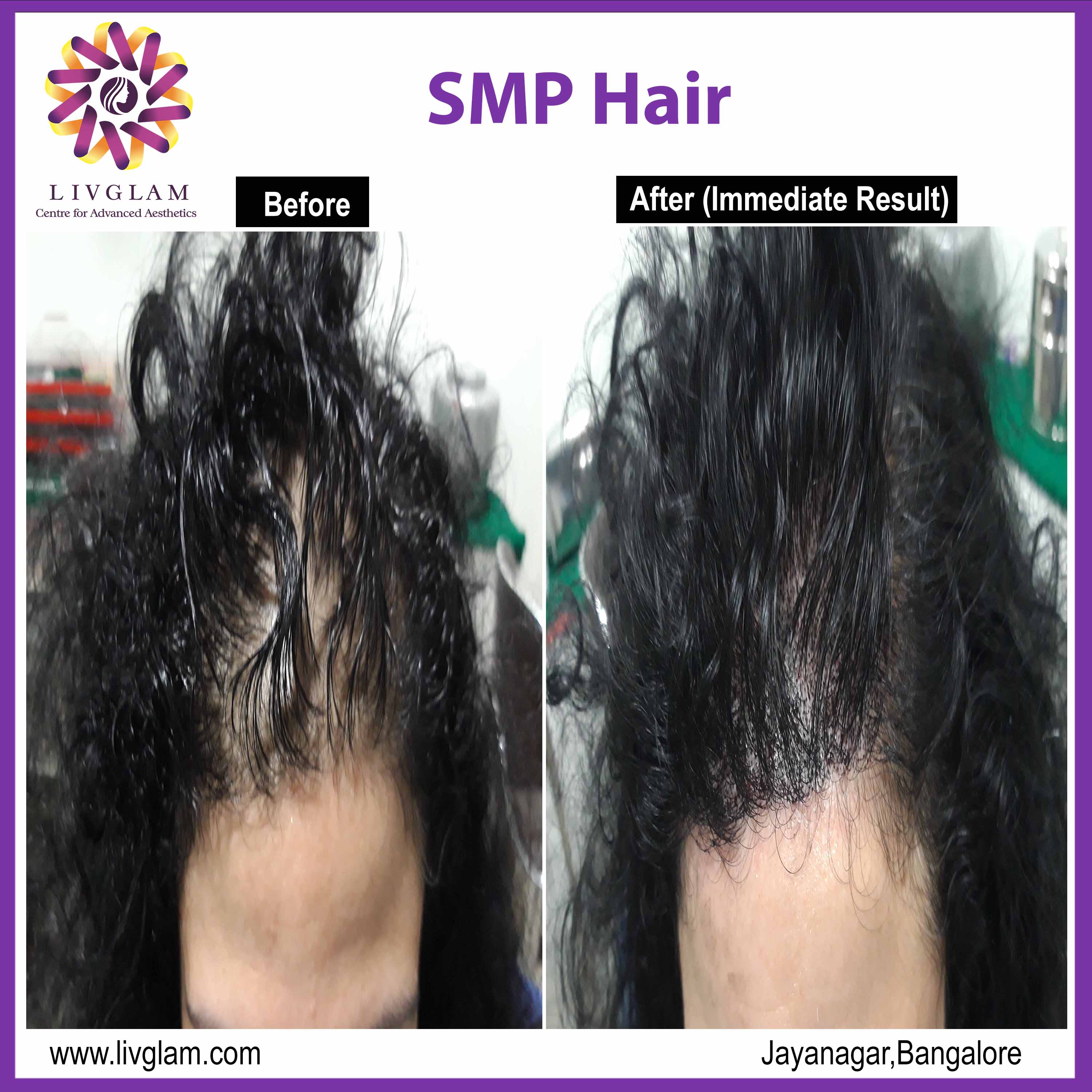 smp hair treatment cost in bangalore