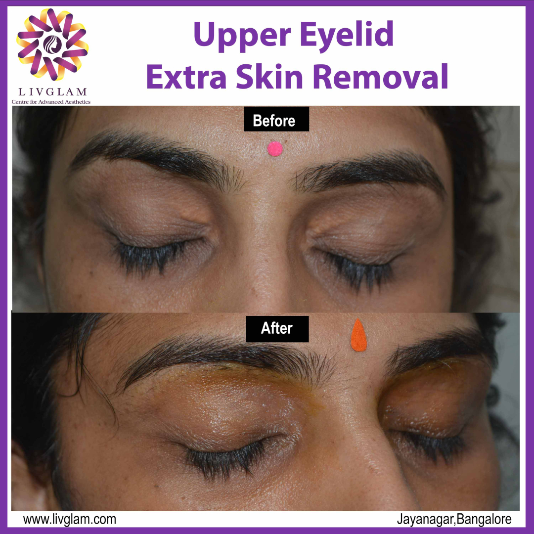 Upper eye lid extra skin removal