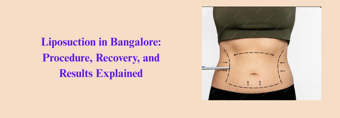 Liposuction in Bangalore: Procedure, Recovery, and Results Explained