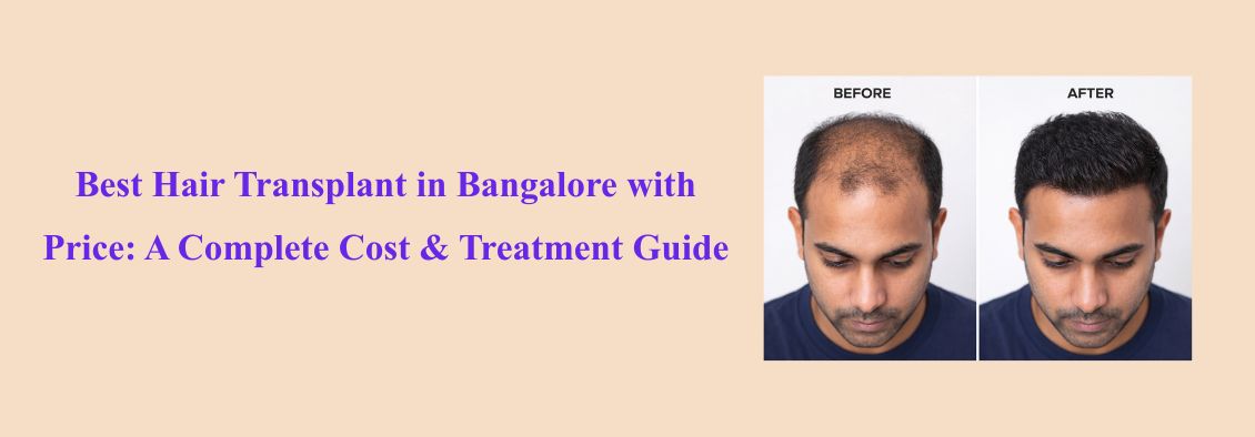 Best Hair Transplant in Bangalore with Price: A Complete Cost & Treatment Guide
