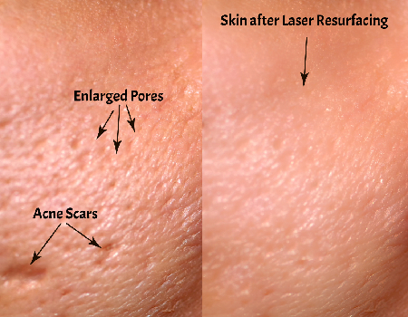 Acne Scar Laser Treatment in Bangalore