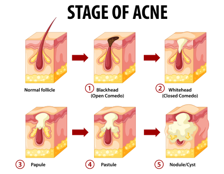 Acne scar Treatment in Bangalore