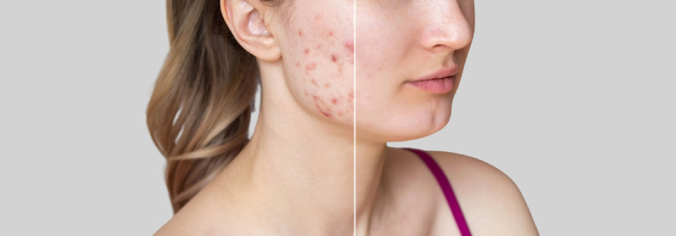 Acne Scar Therapy in Bangalore