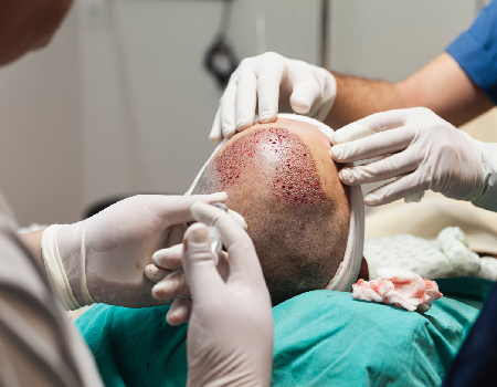 Best Hair Transplant Clinic in Bangalore Image