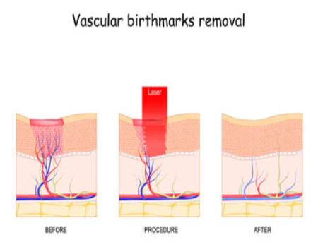 birthmark-removal treatment