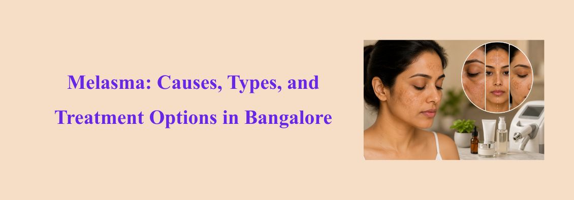 Melasma causes, types and treatment options
