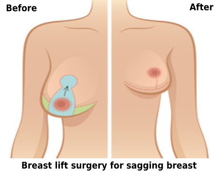 Breast Lift Surgery Cost in Bangalore