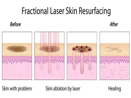Carbon Laser Peel Skin Rejuvenation Treatment Cost in Bangalore