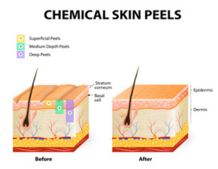Bangalore Chemical Peeling Cost - Visual representation of skin peeling treatment prices.