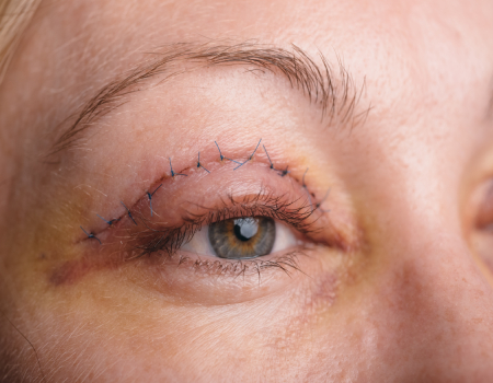 Eyelid Surgery
