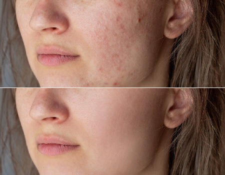 Laser Treatment for Acne Scars Before and After