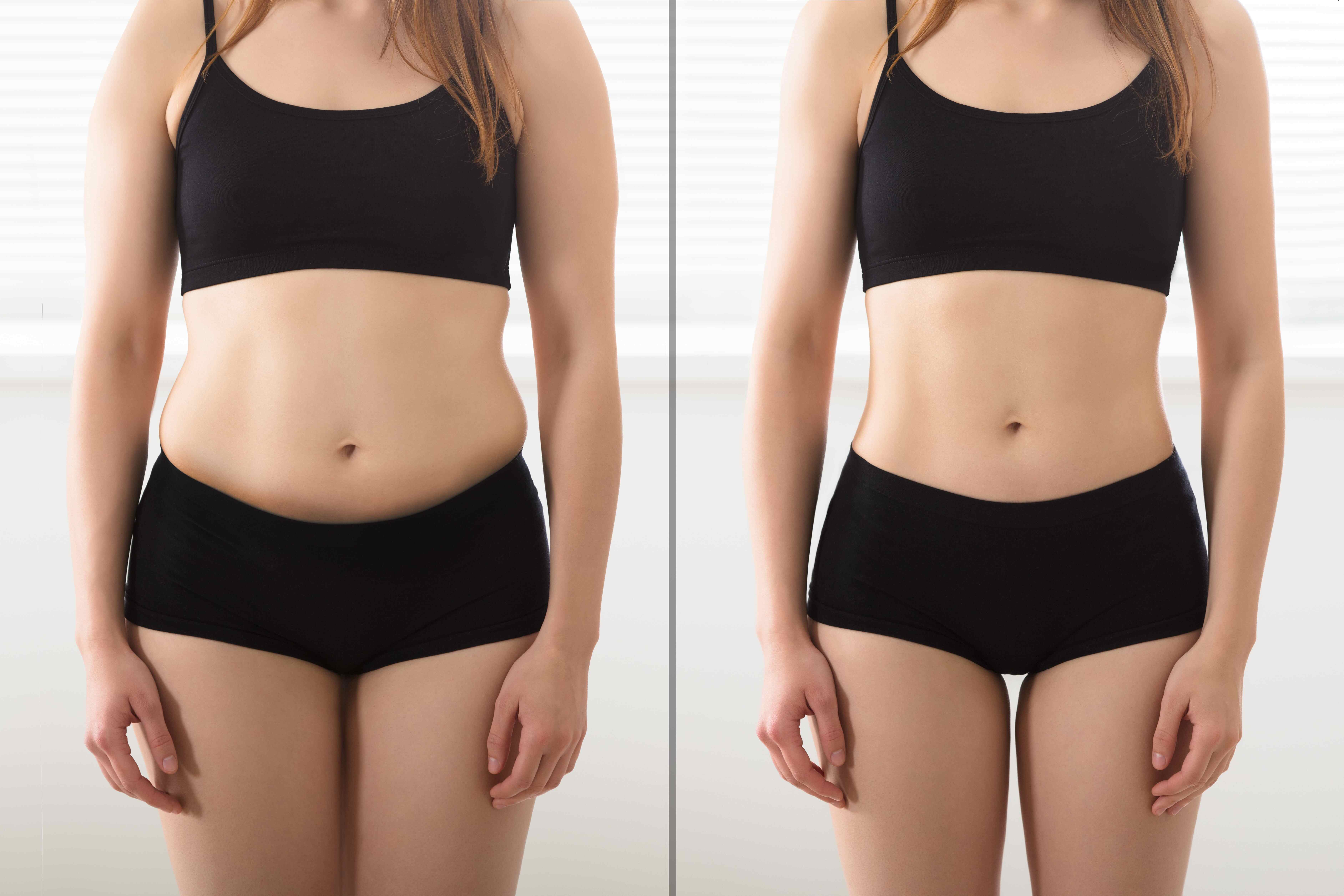 Liposuction Surgery Before and After - Transformative Aesthetic Results