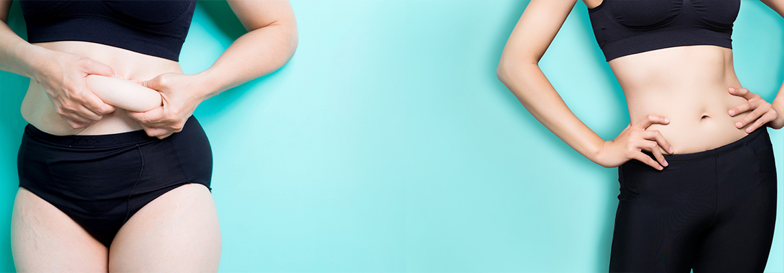 Liposuction