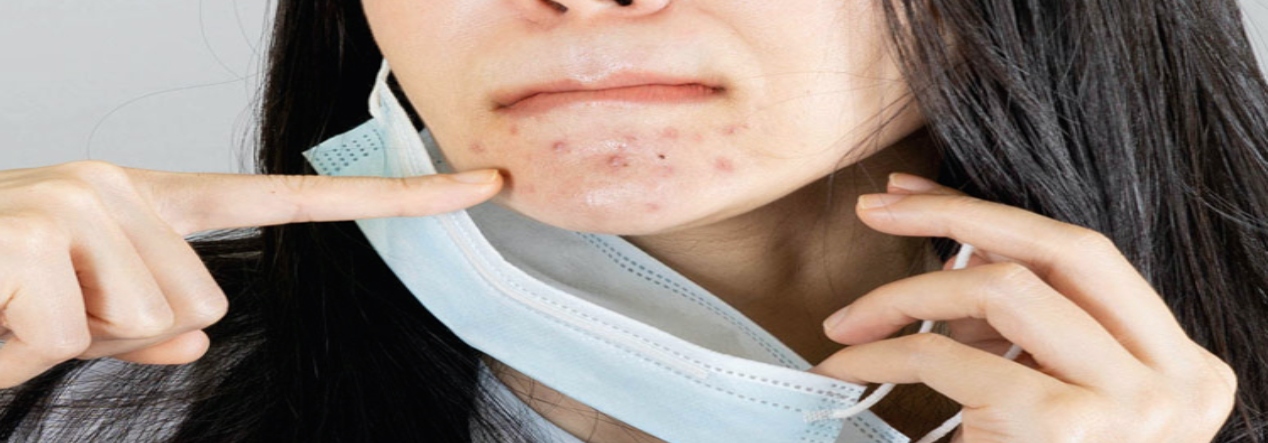 Combat Acne Caused by Wearing Face Mask