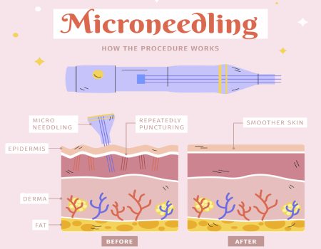 Micro Needling Radio Frequency Treatment