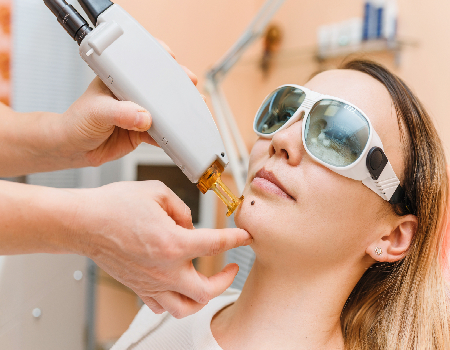 mole removal