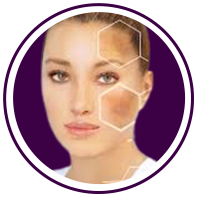 melasma service
