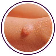 warts service